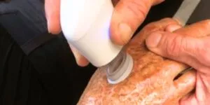 LymphaTouch for Severe Burn Injury thumbnail
