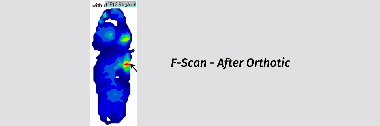 Diabetic Foot Ulcer-02